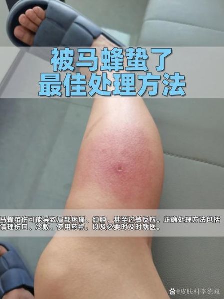 马蜂蜇了怎么办_马蜂窝怎么处理最安全