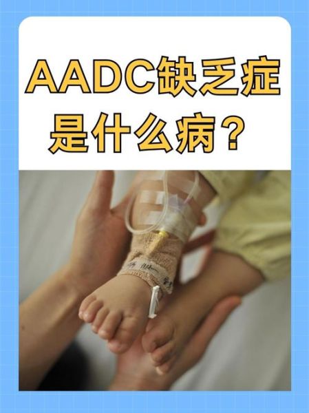 aadc缺乏症是什么_aadc缺乏症能治好吗