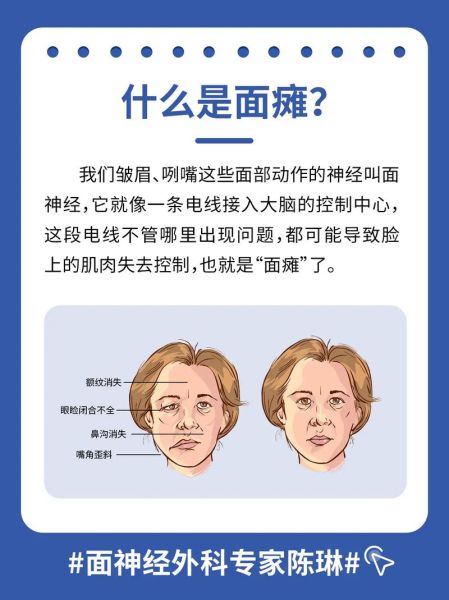 面部怀疑是面瘫吗_面部麻木多久算严重