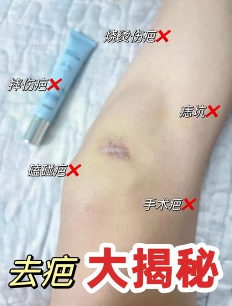 伤痕怎么消除_疤痕修复方法有哪些