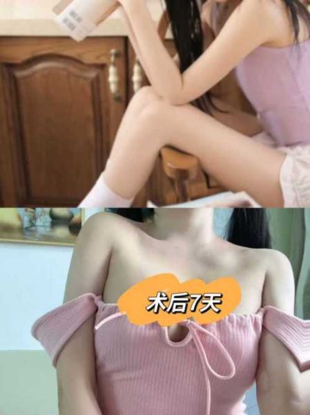 假体隆胸多久恢复自然_假体隆胸术后注意事项