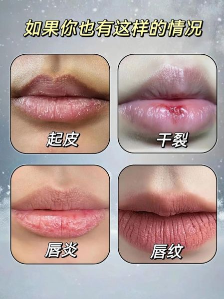 嘴巴破皮吃什么好_嘴巴破皮怎么快速好