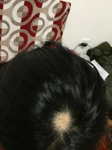 头没头发怎么办_头没头发是什么原因