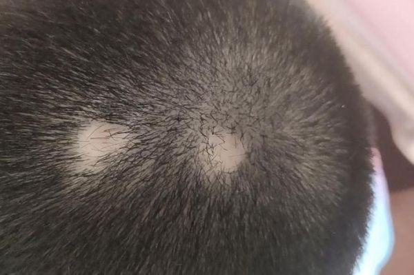 头没头发怎么办_头没头发是什么原因