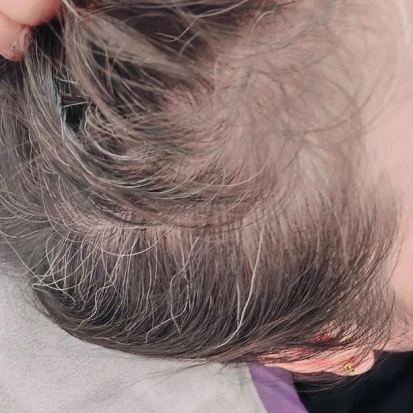 头发熬白了怎么办_头发熬白还能恢复吗