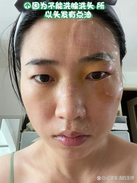 脸部受伤怎么快速消肿_脸部擦伤会留疤吗