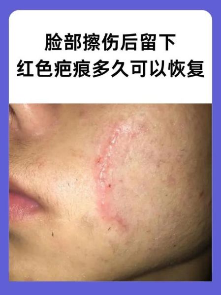 脸部受伤怎么快速消肿_脸部擦伤会留疤吗