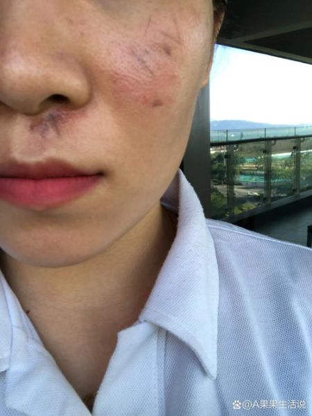 脸部受伤怎么快速消肿_脸部擦伤会留疤吗