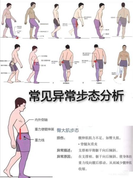 走路踉跄是什么原因_走路踉跄怎么快速缓解