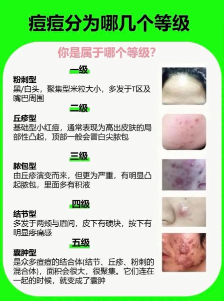 脸上长痘痘是什么原因_怎么快速消除