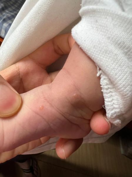 小泡泡是什么_小泡泡怎么消除