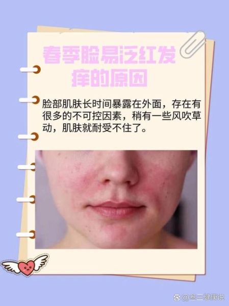脸发红是什么原因_脸发红怎么快速消除