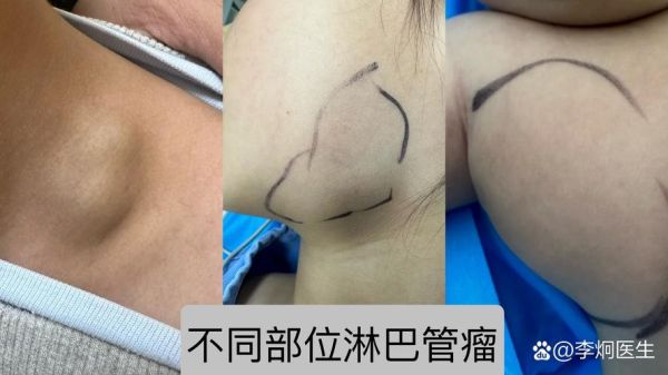 鼓起的包块怎么消除_鼓起的包块是什么病