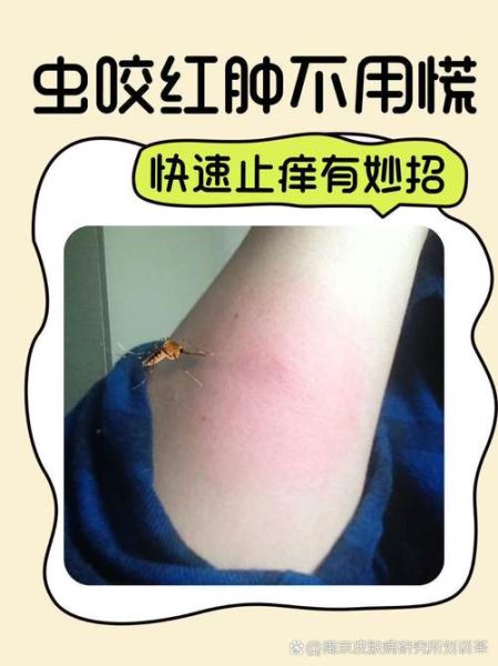 什么虫子咬了会起水泡_怎么快速止痒消肿
