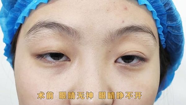 眼睛无光是怎么回事_眼睛无神怎么恢复