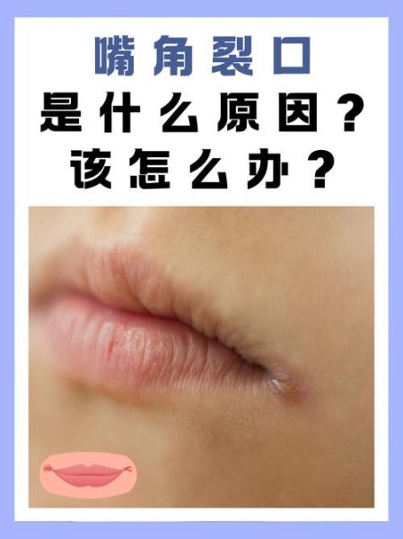 眼睛干涩怎么办_嘴角开裂怎么快速好