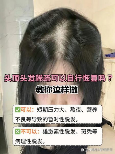 头顶发量稀少怎么办_发量稀少如何增发