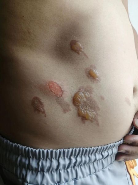 伤口长好了还会疼吗_多久能完全恢复