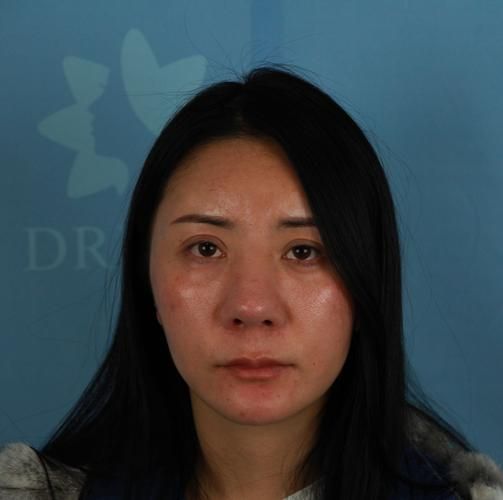 隆鼻会影响财运吗_隆鼻后运势真的会变好吗