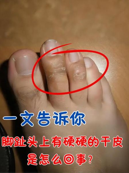 梦到脚趾甲脱落_梦到脚趾甲变长什么意思