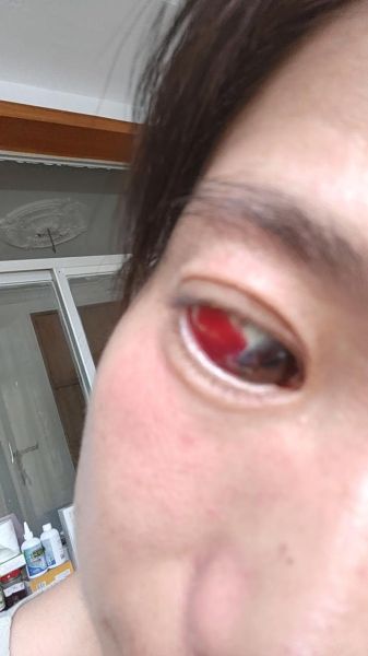 梦见眼睛流血_是什么预兆