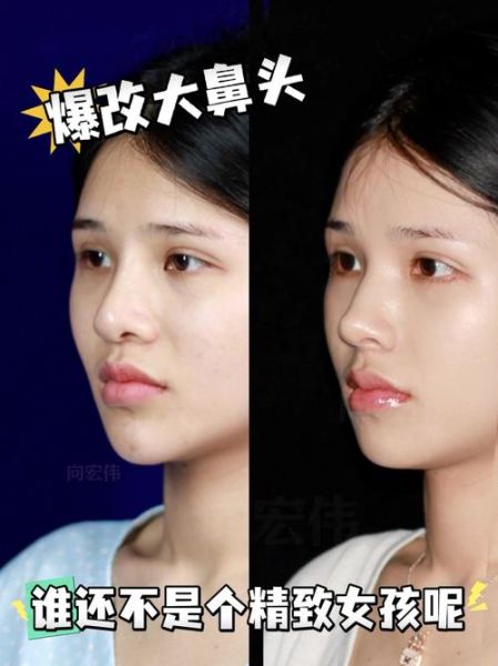 鼻子整容会改变运势吗_隆鼻后运气真的会变好吗