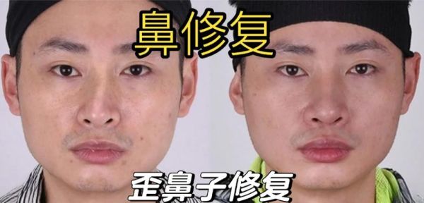 鼻子歪会影响财运吗_鼻子歪如何改善运势