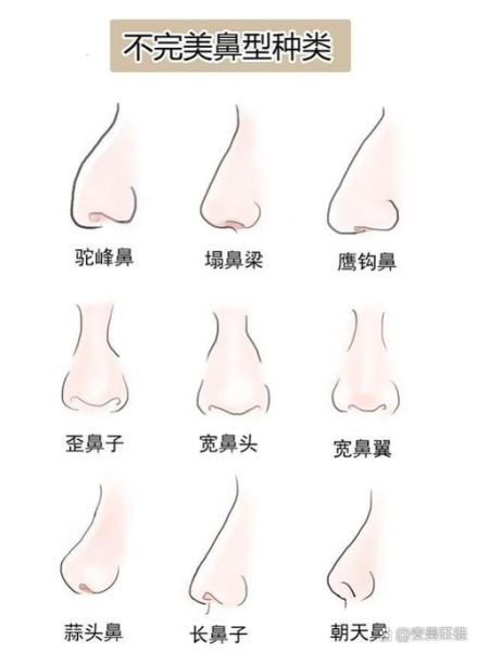 驼峰鼻财运_驼峰鼻影响财运吗