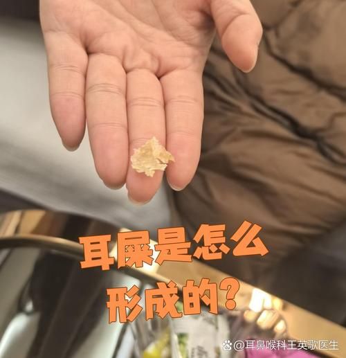 耳屎多代表财运旺吗_耳屎颜色看财运准不准
