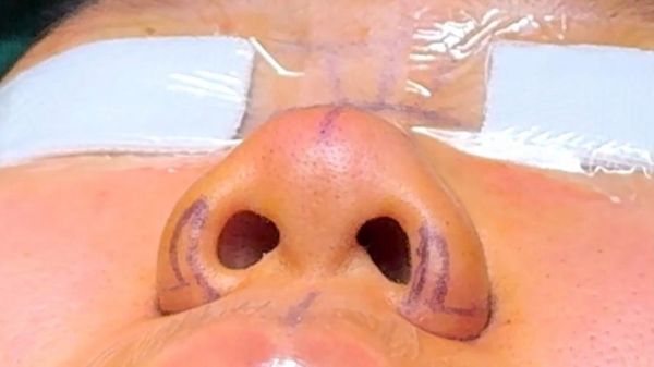 鞍鼻影响运势吗_鞍鼻面相改运方法