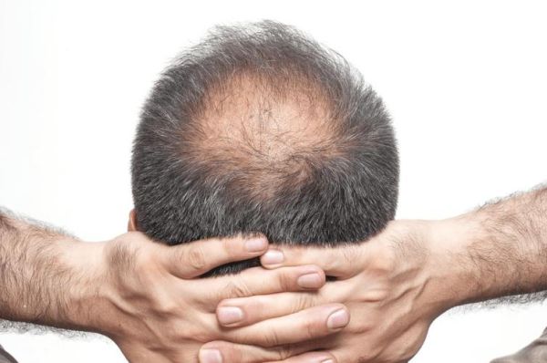 脱发会影响运势吗_脱发人如何转运