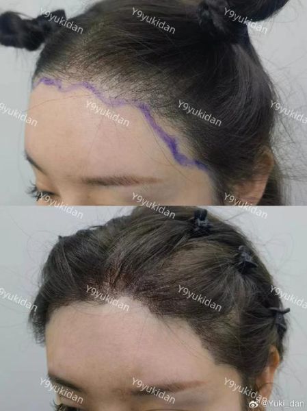 植发际线会影响运势吗_发际线调整风水讲究