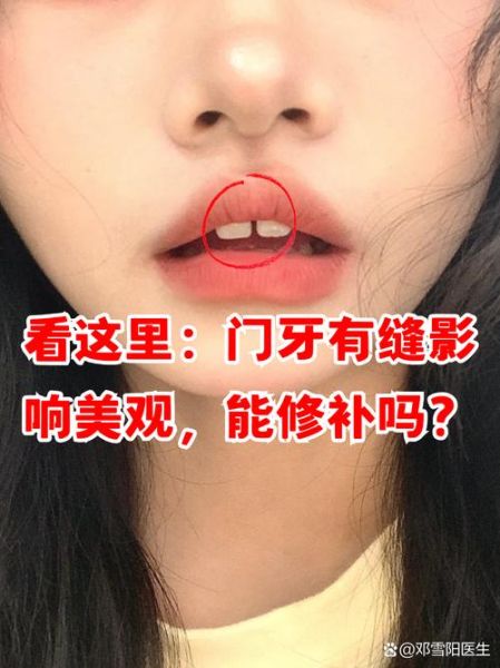 门牙有缝会影响财运吗_门牙缺损怎么补救招财