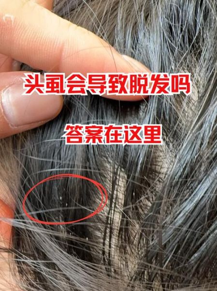 梦到头上长虱子是什么意思_梦见虱子预示什么