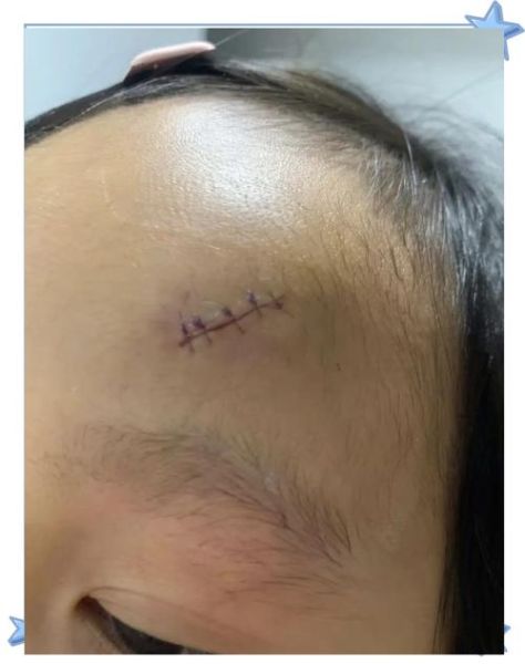 额头有疤影响运势吗_额头疤痕风水破解