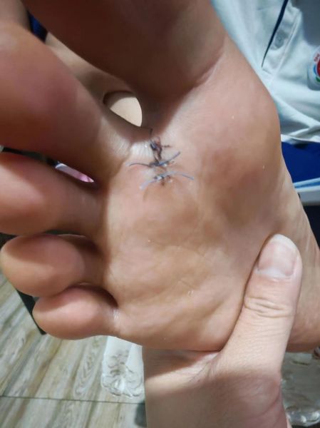 梦到儿子脚受伤_意味着什么