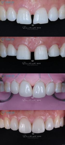 门牙有缝影响财运吗_门牙缺损如何改运