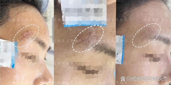 眉毛有疤会影响运势吗_眉毛疤痕怎么改运