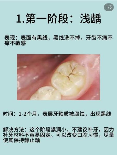 梦到牙齿蛀了_梦见牙齿坏了是什么意思