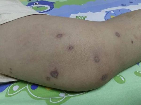 梦到被蜂蛰是什么意思_被蜂蛰预示什么