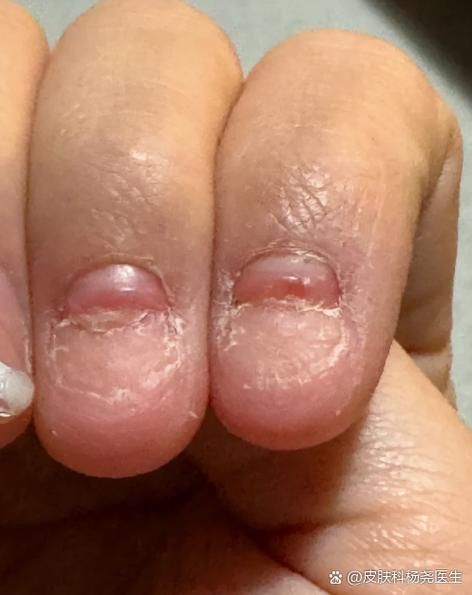 梦到指甲脱落_周公解梦与心理暗示