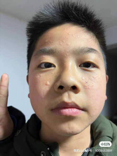 梦到脸上长疙瘩是什么意思_脸上长疙瘩预示什么