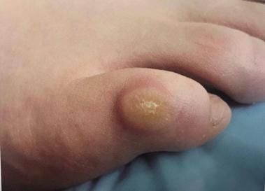 梦到脚长疮是什么意思_脚长疮梦境解析