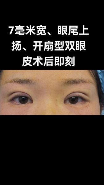 割眼皮会影响财运吗_割双眼皮后运势真的变好吗