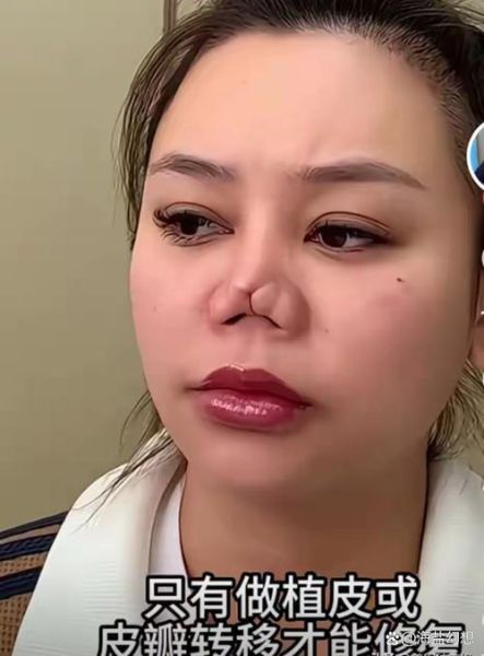 梦到整容鼻子_梦见鼻子整形预示什么