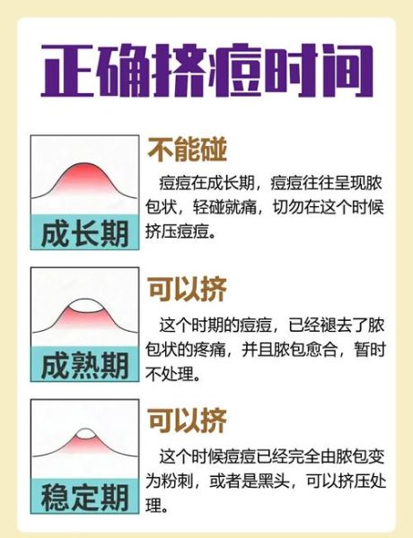 梦到挤粉刺_是什么意思