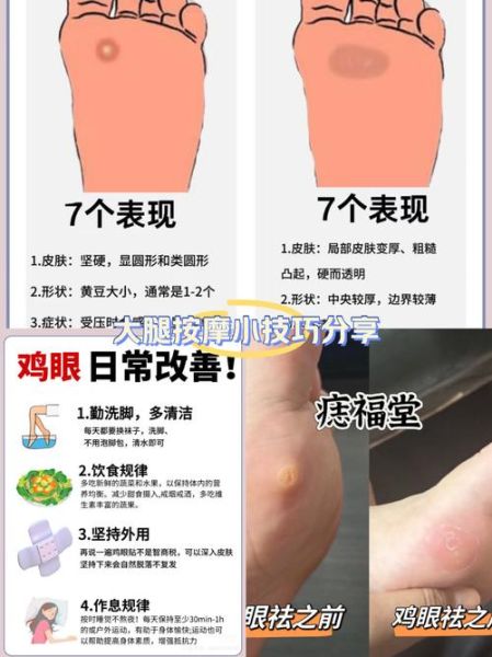 梦到鸡眼是什么意思_梦见鸡眼预示着什么