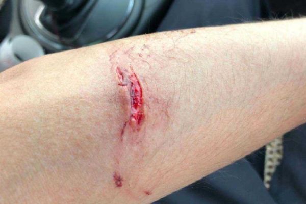 梦到胳膊受伤_梦见胳膊流血