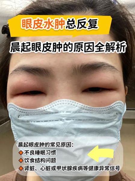 梦到眼睛肿了是什么意思_眼睛肿梦境解析