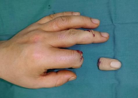 梦到亲人手断了是什么意思_梦到亲人手断了预示什么